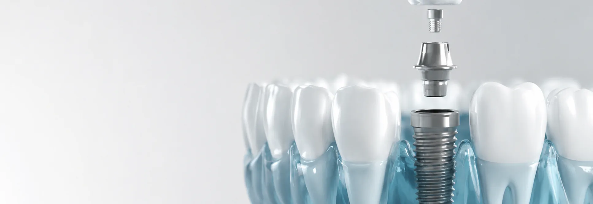 Computer guided dental implants at Woolbert Dental
