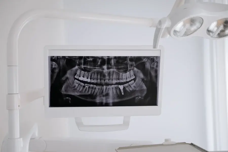 A digital dental X-ray displayed on a treatment room monitor