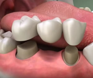 Link to more info about Dental Crowns and Bridges