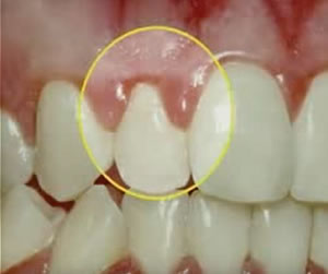 Gum Disease Treatment