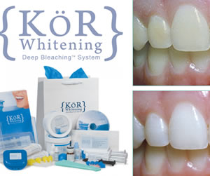 Kor Teeth Whitening