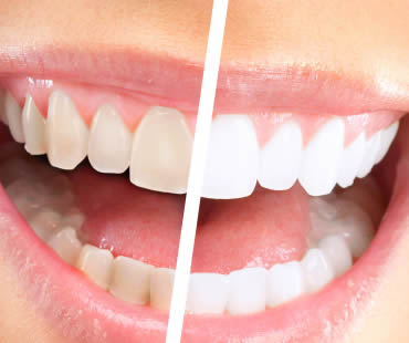 Teeth Whitening Trends