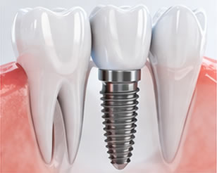Implant Dentistry