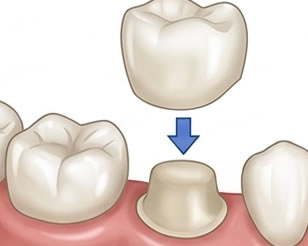 Porcelain Crowns